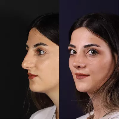 عکس های قبل و بعد جراحی زیبایی صورت | از عمل بینی تا ژل لب❤️